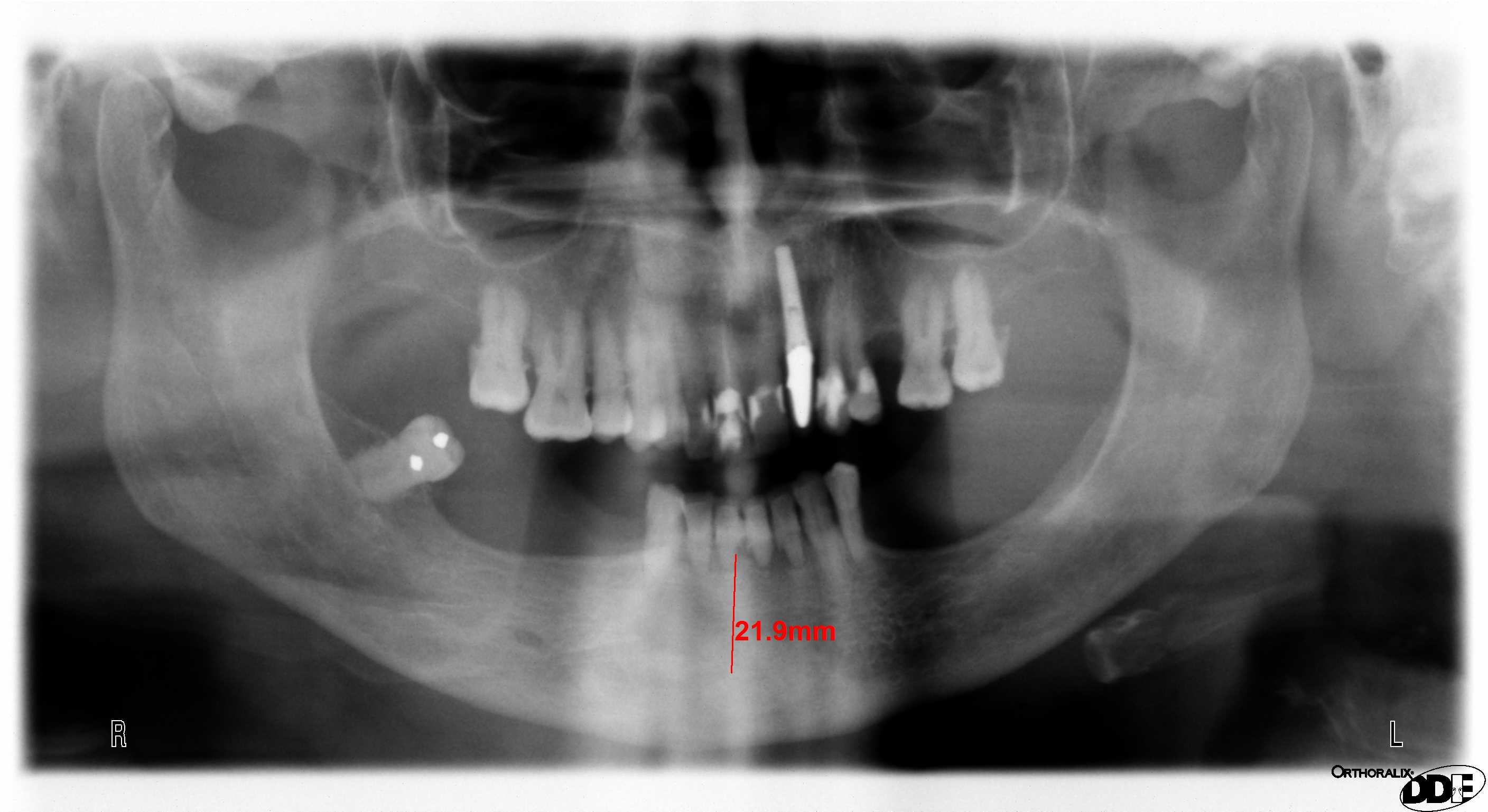 Denti fissi subito con l'implantologia a carico immediato